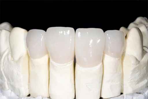 Image result for dental crowns